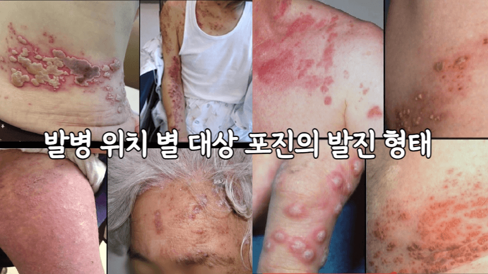 대상포진: 원인부터 치료까지 완벽 가이드 2 ywAAAAAAQABAAACAUwAOw==