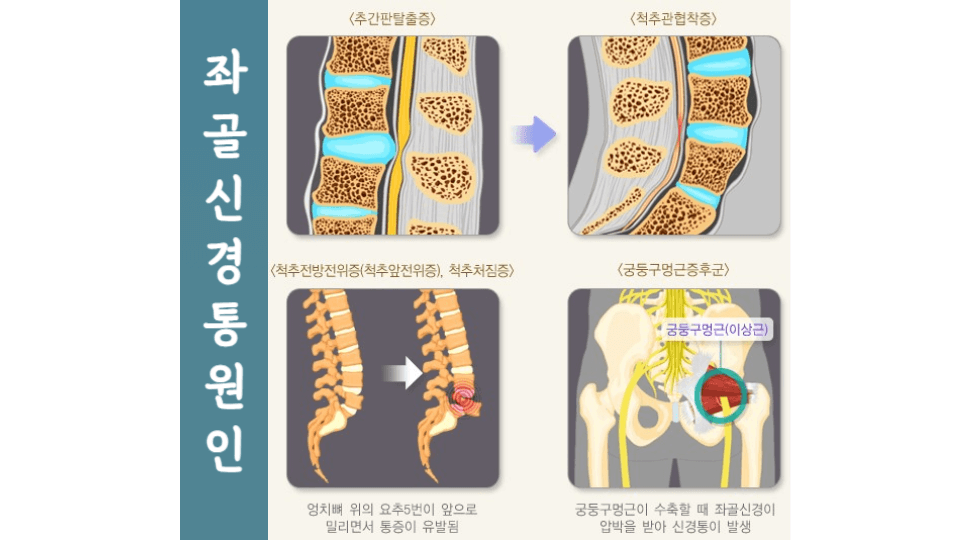 좌골 신경통: 허리부터 발끝까지 통증에서 벗어나는 방법 2 좌골신경통원인