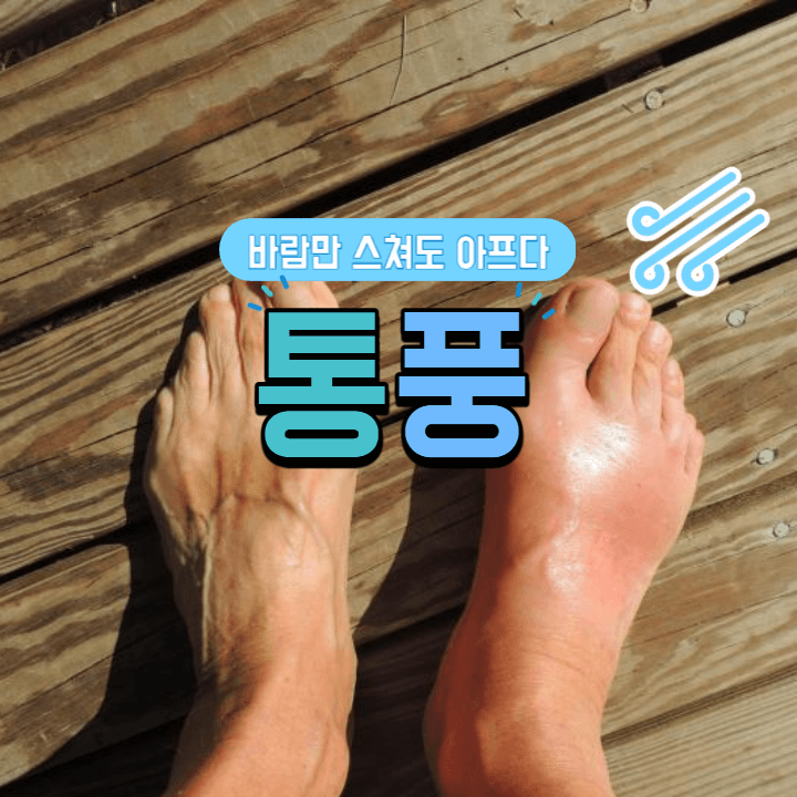 20~30대 젊은 환자 급증: 통풍(gout)이란? 1 통풍-gout