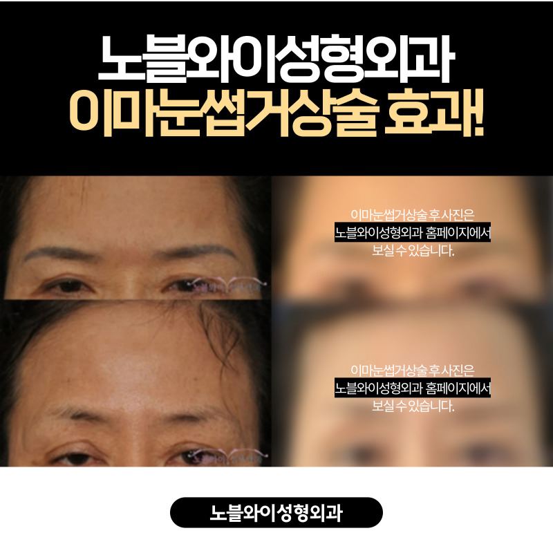 노블와이성형외과 블로그 :: '이마눈썹거상술' 태그의 글 목록