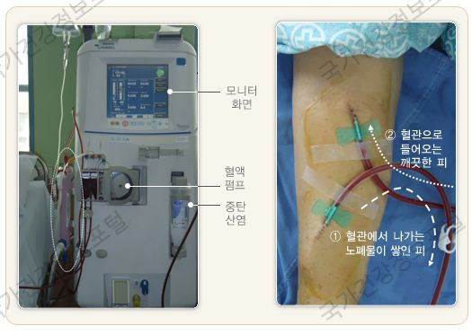 신장투석 비용, 음식, 장애등급 알아봅니다.
