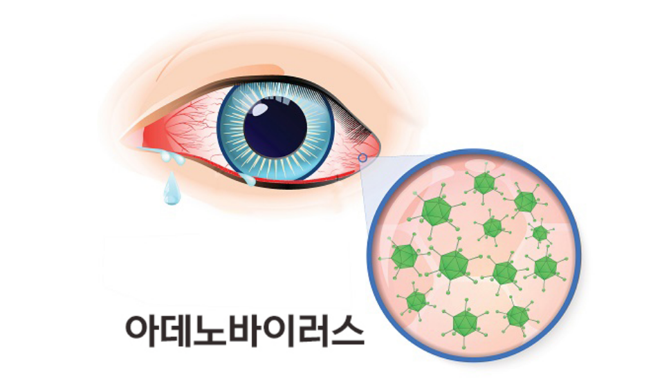 아데노 바이러스 증상(결막염.전염)