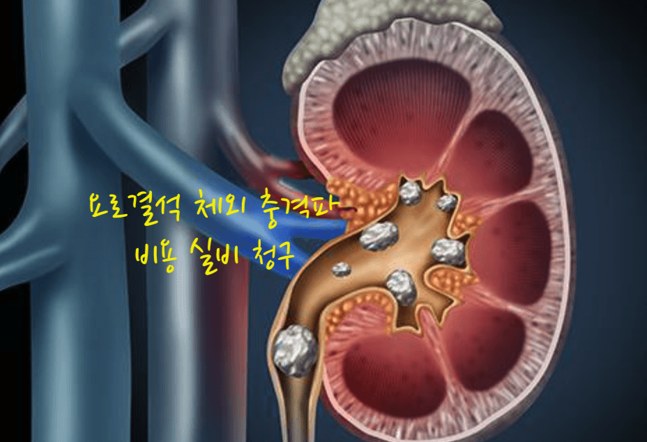 요로결석 체외 충격파 비용 실비 청구