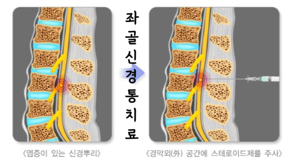 좌골 신경통: 허리부터 발끝까지 통증에서 벗어나는 방법 3 좌골신경통치료-스테로이드주사