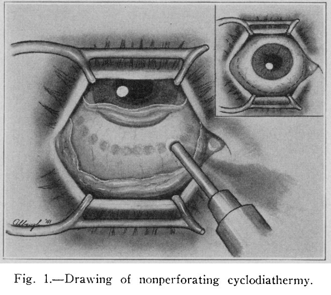 섬모체 광응고술 (CycloPhotoCoagulation, CPC) 의 개념, 의미, 종류