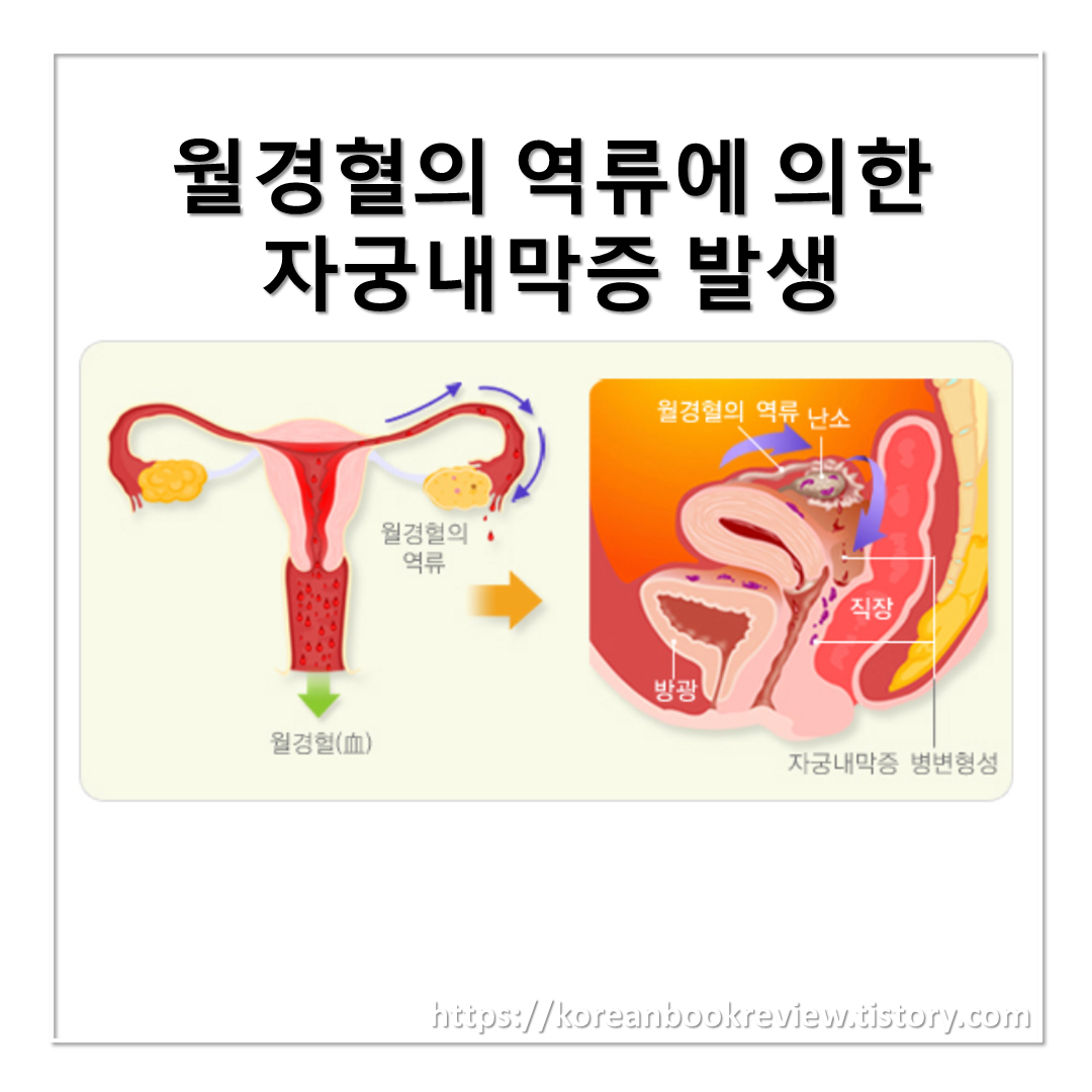 자궁내막증 의미, 정의, 뜻, 원인, 증상, 증세, 경과, 예후, 진단, 검사, 월경 통증