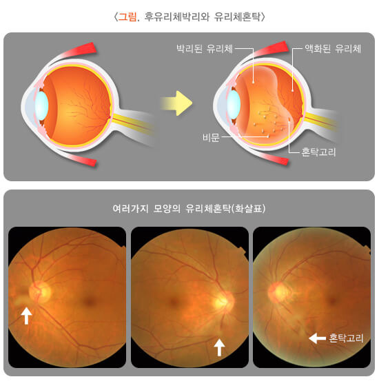 눈 앞에 날파리가? : 비문증(muscae volitantes) 3 후유리체 박리와 유리체 혼탁