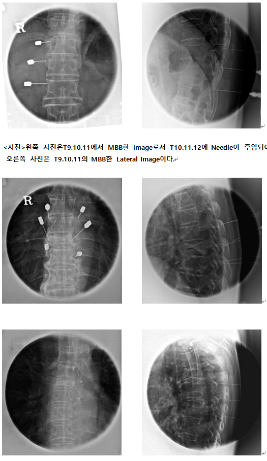 - 0.5% lidocaine cc and tamceton was injected into each needle