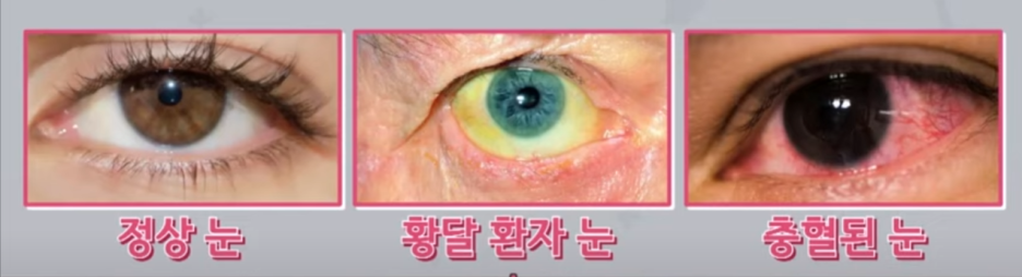 황달 원인 증상 수치 관련질환 신생아 황달 모든것 3 ywAAAAAAQABAAACAUwAOw==