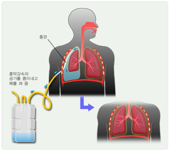 기흉이란? 원인, 증상, 치료 및 병원 선택 방법
