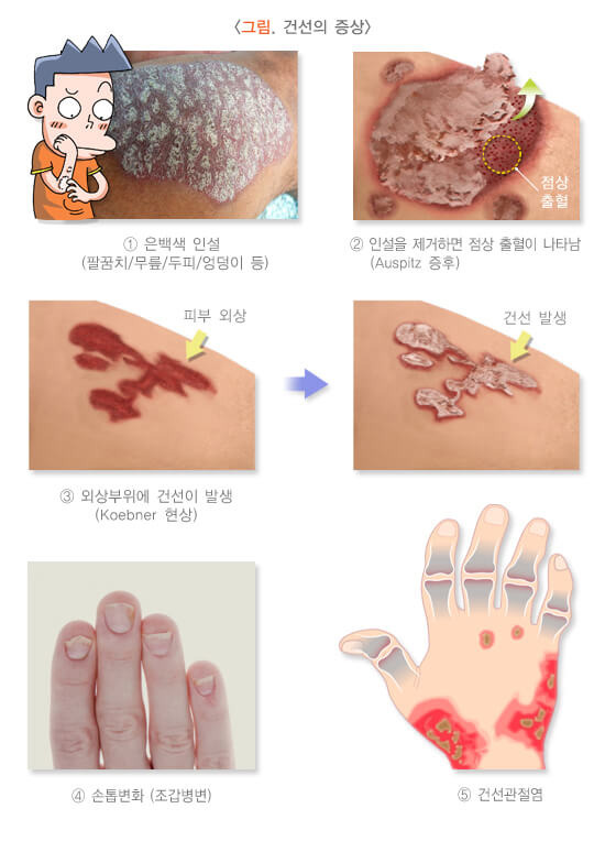 가려움과 각질에 스트레스. 건선이란 무엇인가? 2 ywAAAAAAQABAAACAUwAOw==