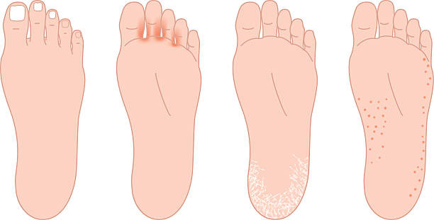 발톱무좀증상과 치료,무좀종류