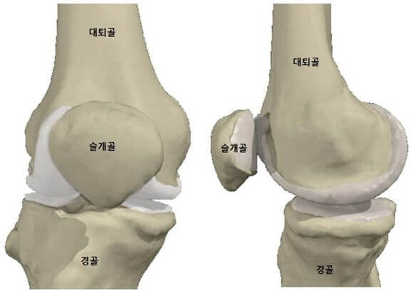 무릎연골파열 수술 주사 비용 깔끔정리했어요