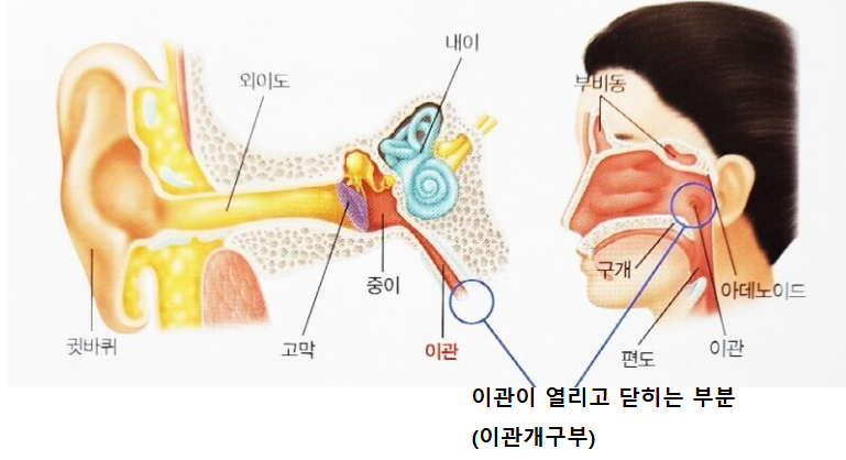 아이유가 앓는 이관개방증 은 무엇? (증상, 원인, 치료법)