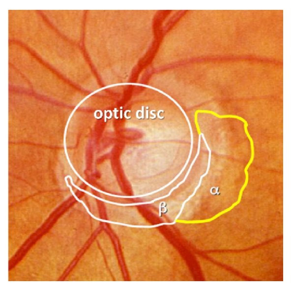 유두주위 맥락망막위축, Peripapillary atrophy, PPA 와 노년성경화, Senile sclerosis