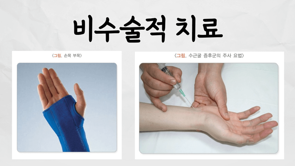 찌릿찌릿 저린 손목: 손목 터널 증후군(carpal tunnel syndrome) 4 손목터널증후군 비수술적치료