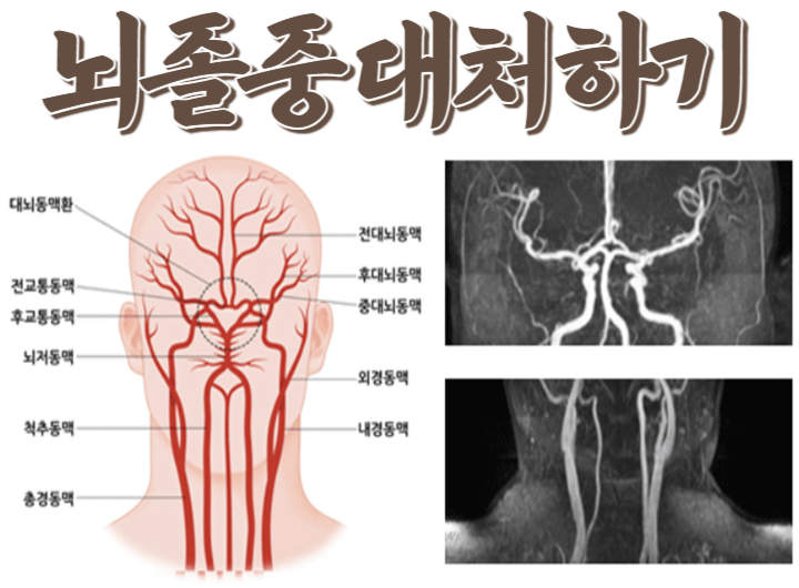 뇌졸중 : 응급 상황에서 이건 제발 하지 마세요! 1 ywAAAAAAQABAAACAUwAOw==