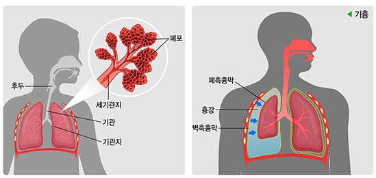 기흉이란? 원인, 증상, 치료 및 병원 선택 방법