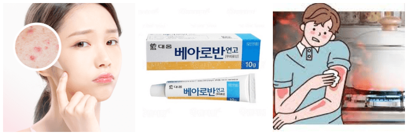 여드름, 화상, 습진에 좋은 베아로반 연고 효능, 사용법, 부작용, 가격 정보