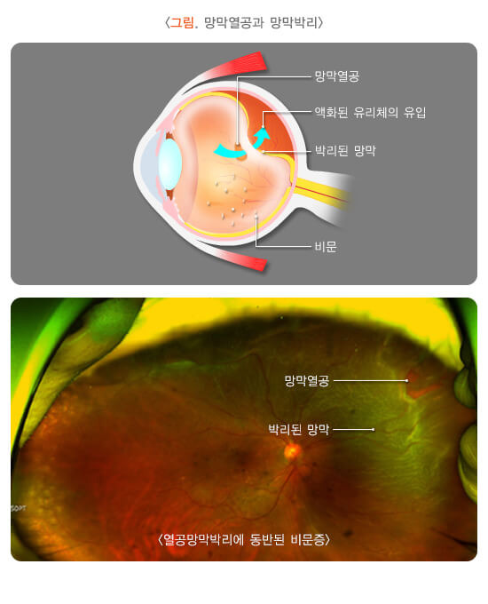 눈 앞에 날파리가? : 비문증(muscae volitantes) 4 망막열공과 망막박리