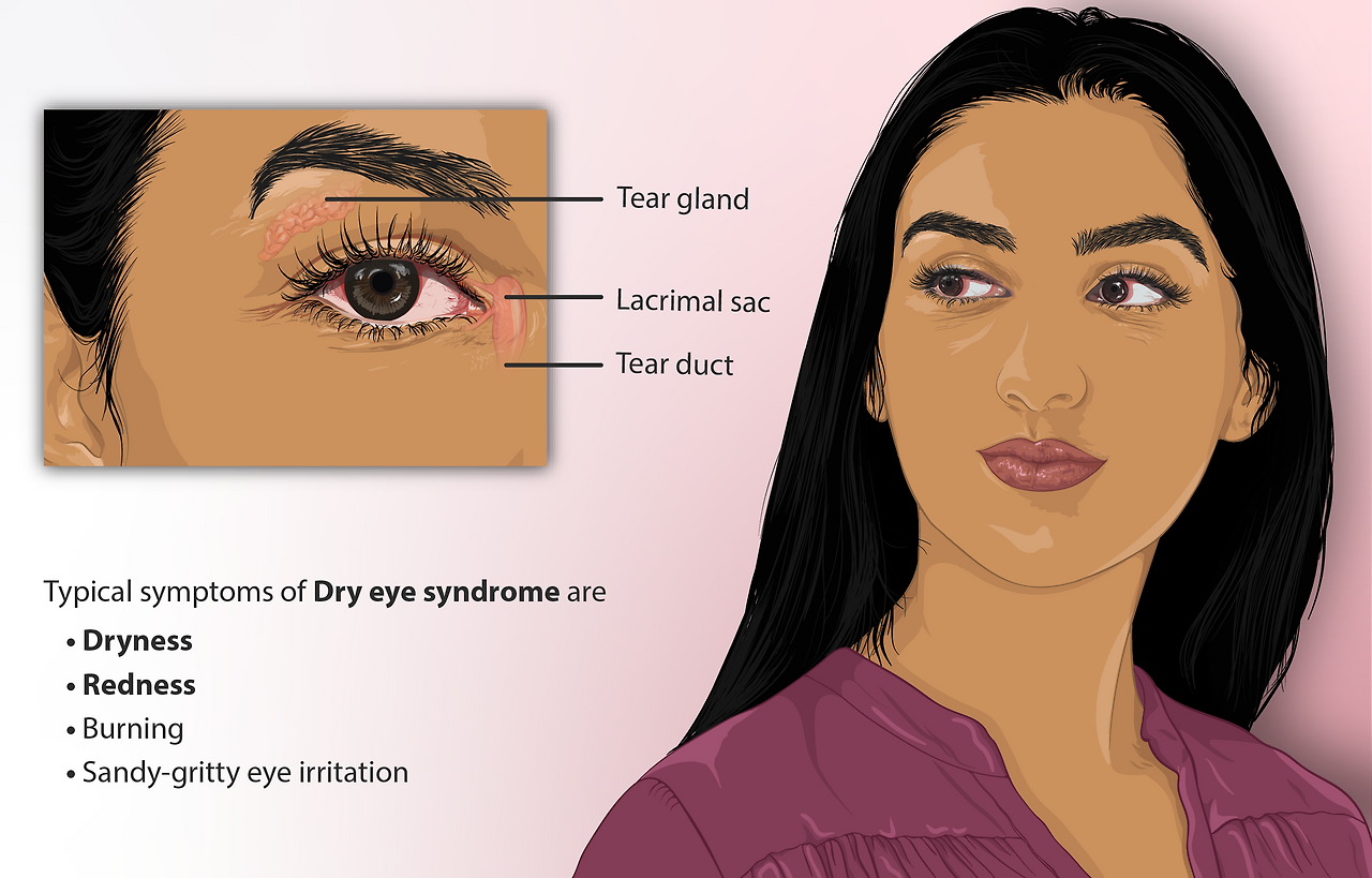 Dry eyes, cause, prevention, symptoms, treatment