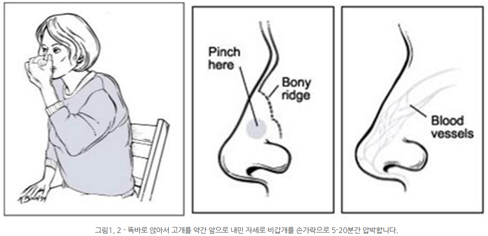 코피 원인과 코피 멈추는 방법