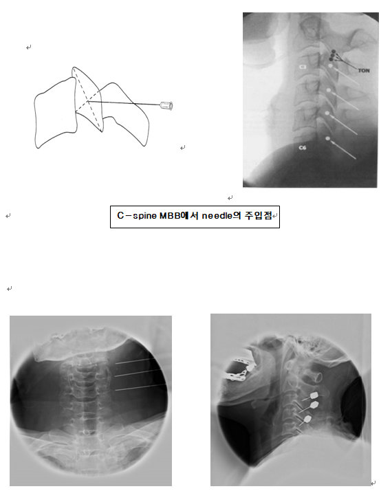 1) T-spine MBB(T-spine medial 지 블록 )