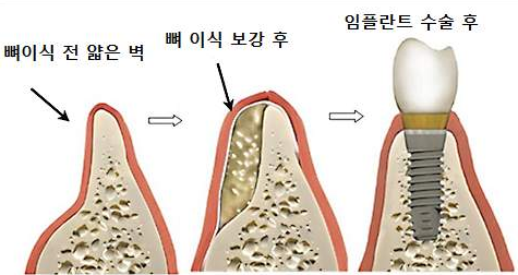 임플란트 뼈이식 비용 (가격, 실손보험적용)