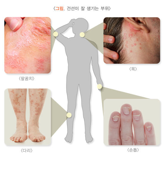 가려움과 각질에 스트레스. 건선이란 무엇인가? 3 ywAAAAAAQABAAACAUwAOw==