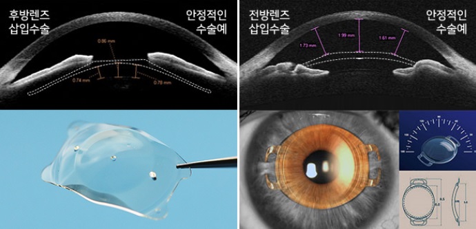 ICL렌즈삽입술 총정리, 수술 전 꼭 알아둘 점