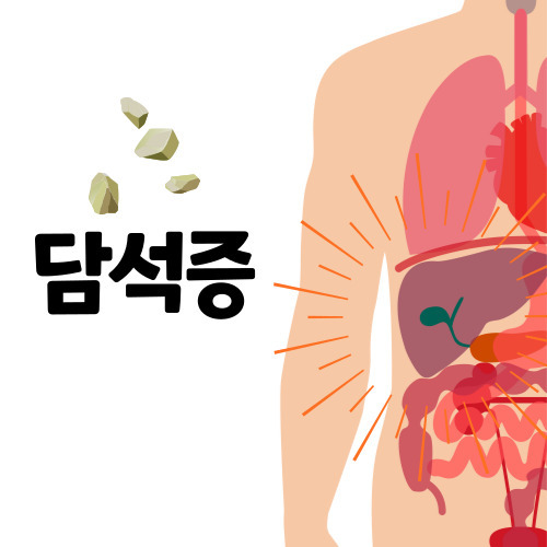 담석제거수술 후기 담석증 명치 등 통증