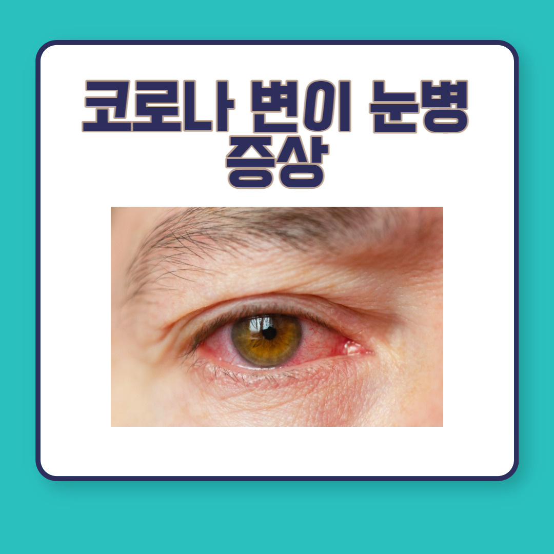 코로나 변이 눈병 결막염 원인 증상 전파력 예방법 알아보기