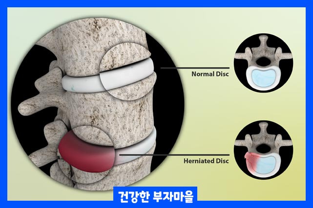추간판 탈출증 (경추, 요추, 증상, 치료 방법)