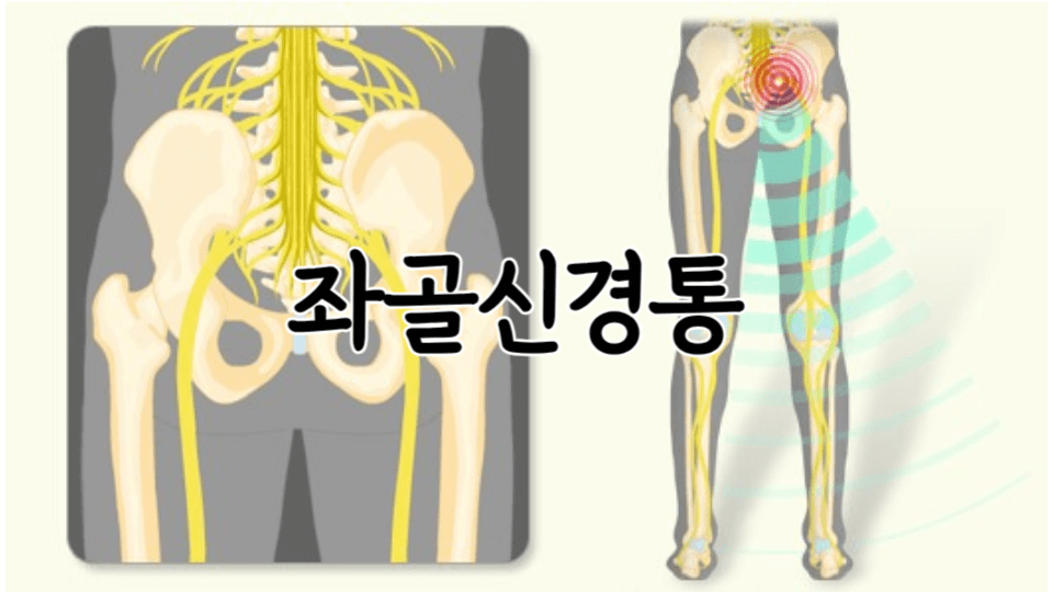 좌골 신경통: 허리부터 발끝까지 통증에서 벗어나는 방법 1 좌골 신경의 구조-좌골신경통의 양상