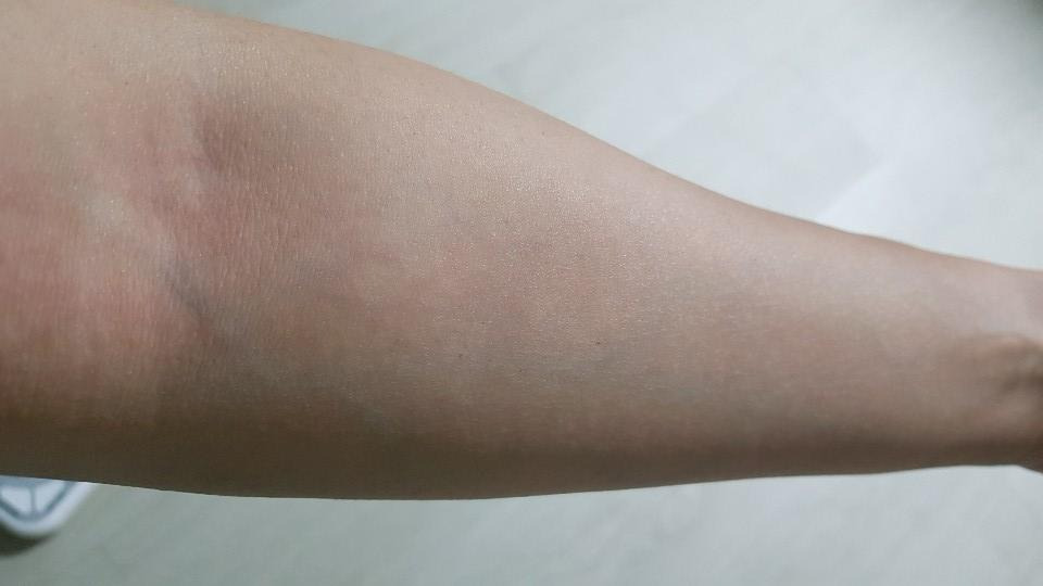 습진, 증상과 원인 및 치료 - 실행하는 방작가