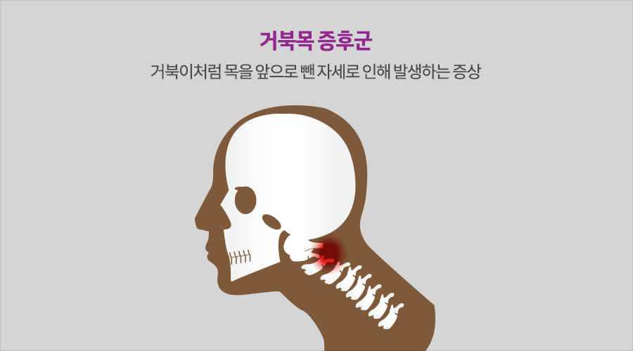 건강한 자세로 컴퓨터 작업하기: 올바른 모니터 높이로 거북목 예방하세요. 1 ?scode=mtistory2&fname=https%3A%2F%2Fblog.kakaocdn.net%2Fdn%2FbPkVcT%2FbtsmcM6W6C0%2Fu28X0TtStmq4At5n2nP3F1%2Fimg