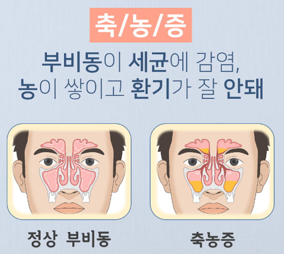 비염 축농증