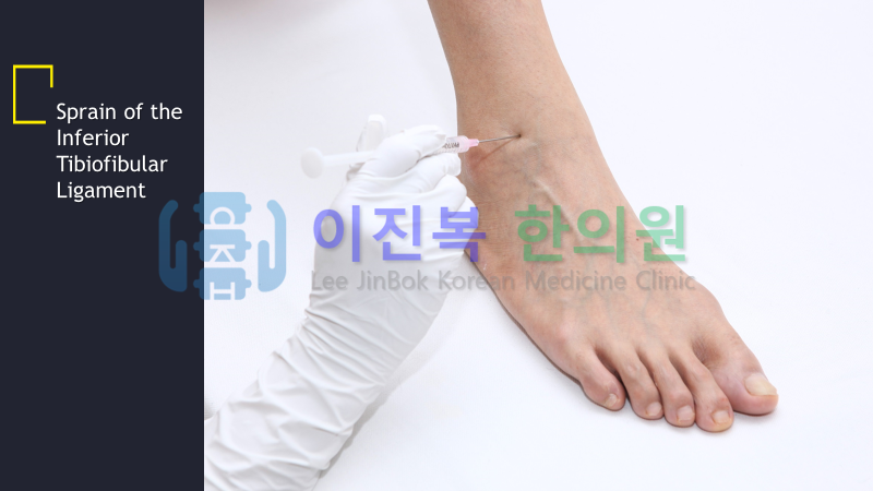 전주 이진복한의원 족관절 염좌(발목 염좌)