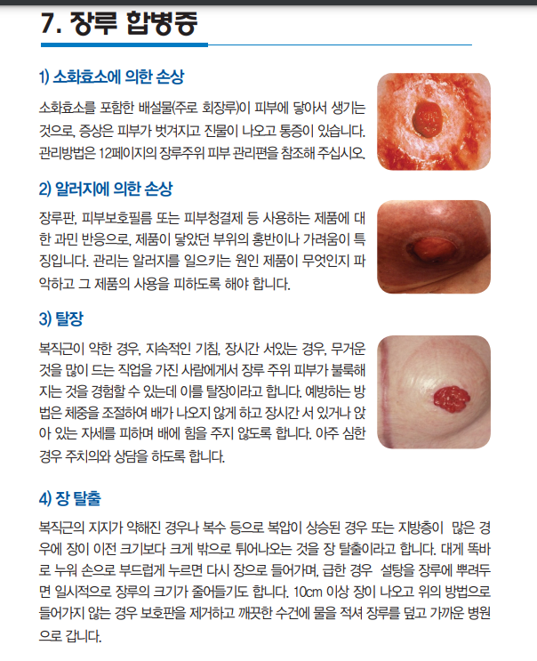 장루란?,장루종류와형태.장루교체방법.장루합병증