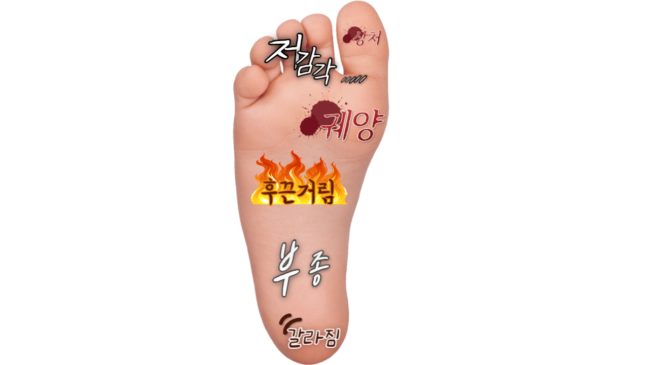 겨울 철 당뇨 합병증 관리 : 절단을 부르는 당뇨 발이란 무엇인가? 2 ywAAAAAAQABAAACAUwAOw==