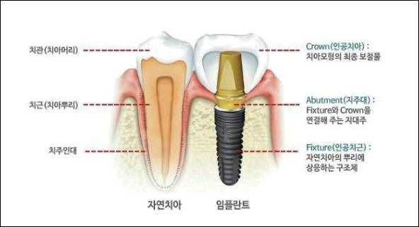 신사동 압구정 임플란트 가격 잘하는 곳 치과 추천 Top 10 오스템 수면 틀니 원데이 어금니 한국건강포탈