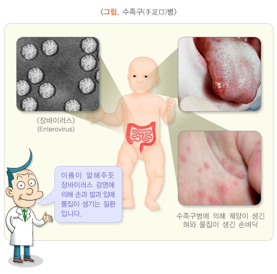 수족구병 완벽 가이드: 증상부터 예방까지 1 수족구병