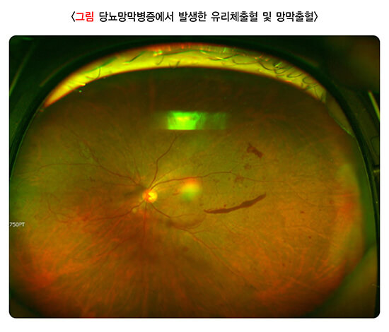 눈 앞에 날파리가? : 비문증(muscae volitantes) 5 당뇨로인한 유리체 출혈 및 망막출혈