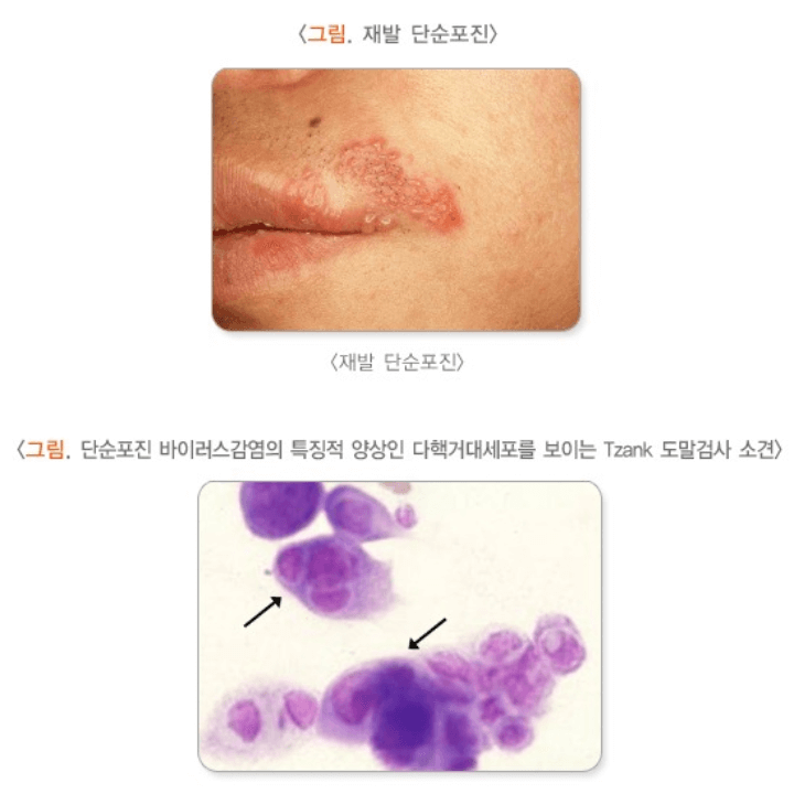 헤르페스 바이러스 감염 : 완치는 불가능하지만 이렇게 예방하세요! 2 단순포진-헤르페스 감염