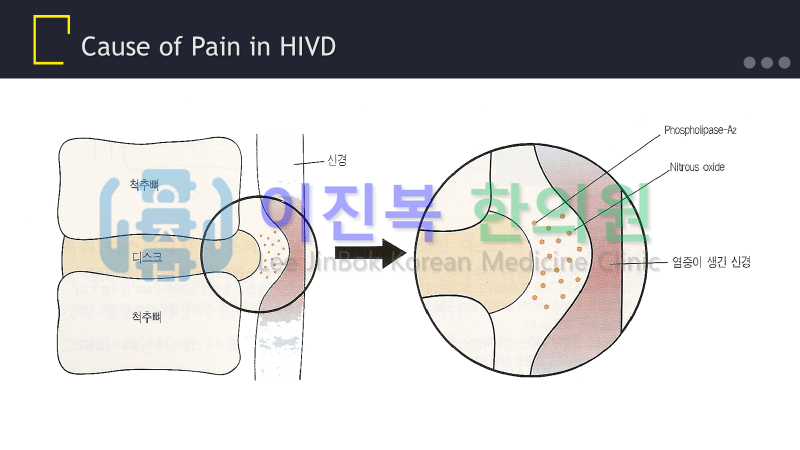 전주 이진복한의원 경추 추간판탈출증(경추 디스크)