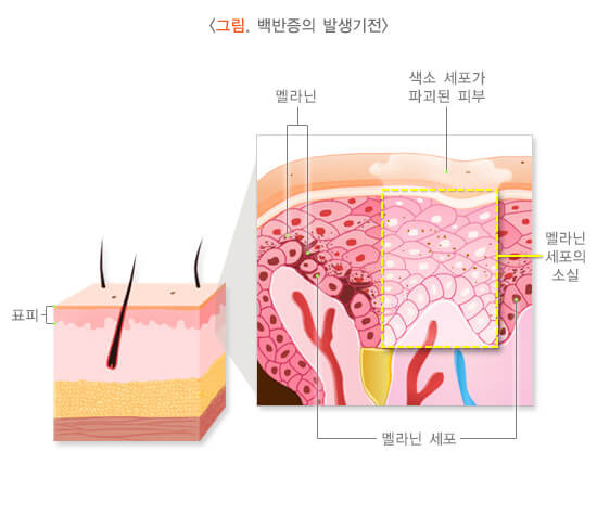피부에 생기는 흰 반점: 백반증(Vitiligo) 2 ywAAAAAAQABAAACAUwAOw==