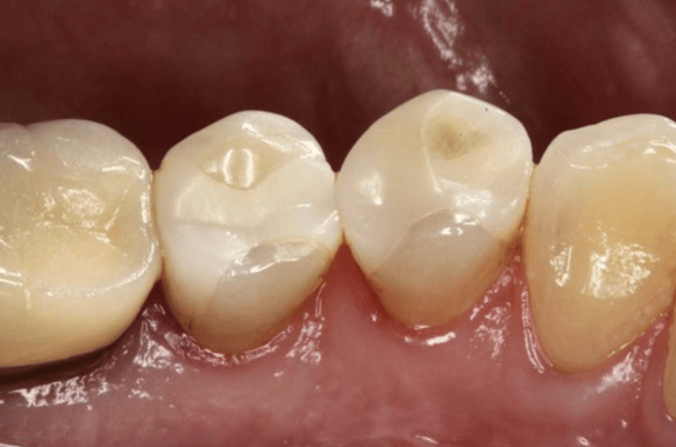 이맥스 세라믹 골드 인레이 가격 차이