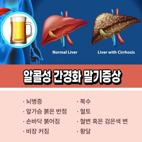 알콜성 간질환 간경화 증상 치료법 좋은 음식 7가지 9933