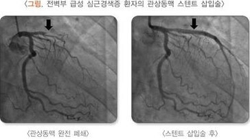 급성 심근경색의 원인 및 치료와 예방에 대한 모든 것 3 ywAAAAAAQABAAACAUwAOw==