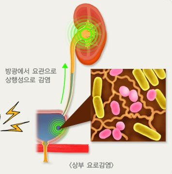 감염 부위와 단순성 여부에 따른 요로감염에 대해 3 상부요로감염